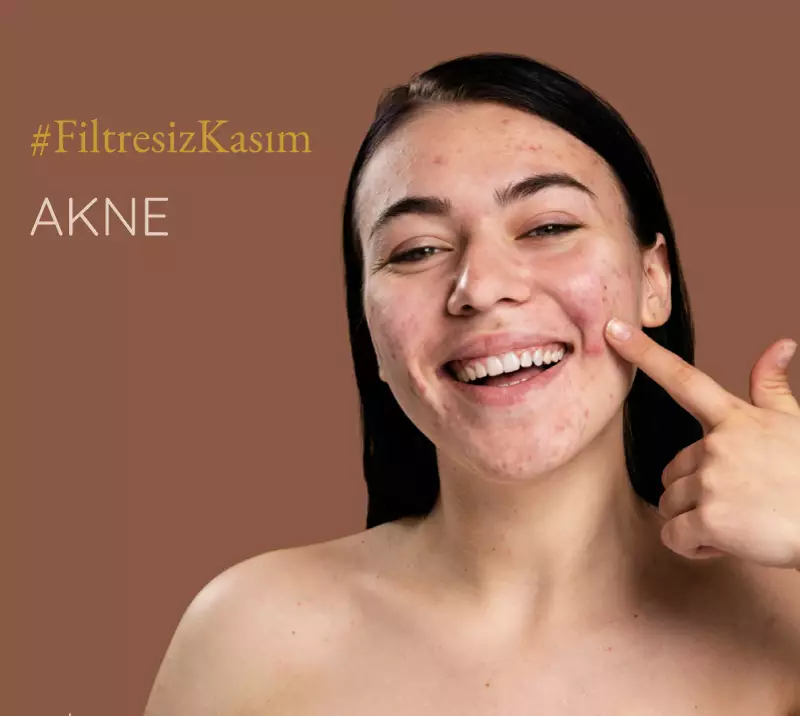 filtresiz kasım, akne