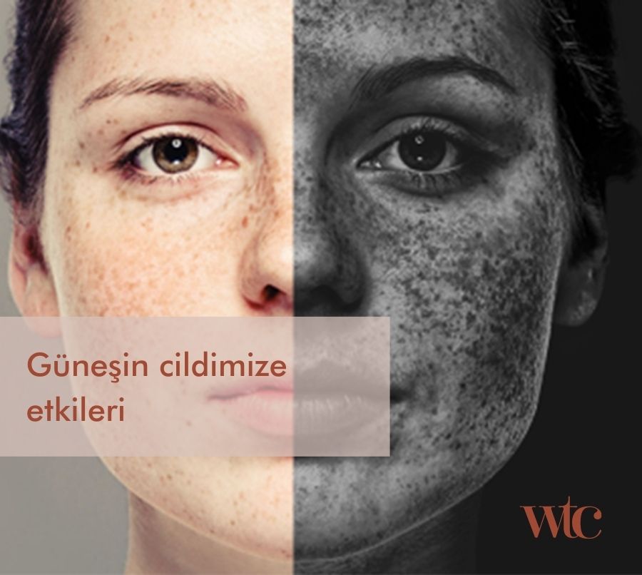 güneş, UV ışınları, UVB, UVA, güneş kremi, cilt kanseri, güneşten korunma, erken yaşlanma, bronzlaşma 