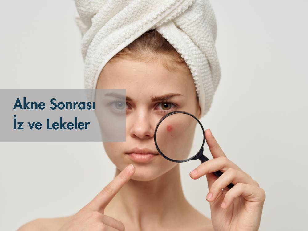 akne, akne lekesi, leke, cilt bakımı, leke tedavisi